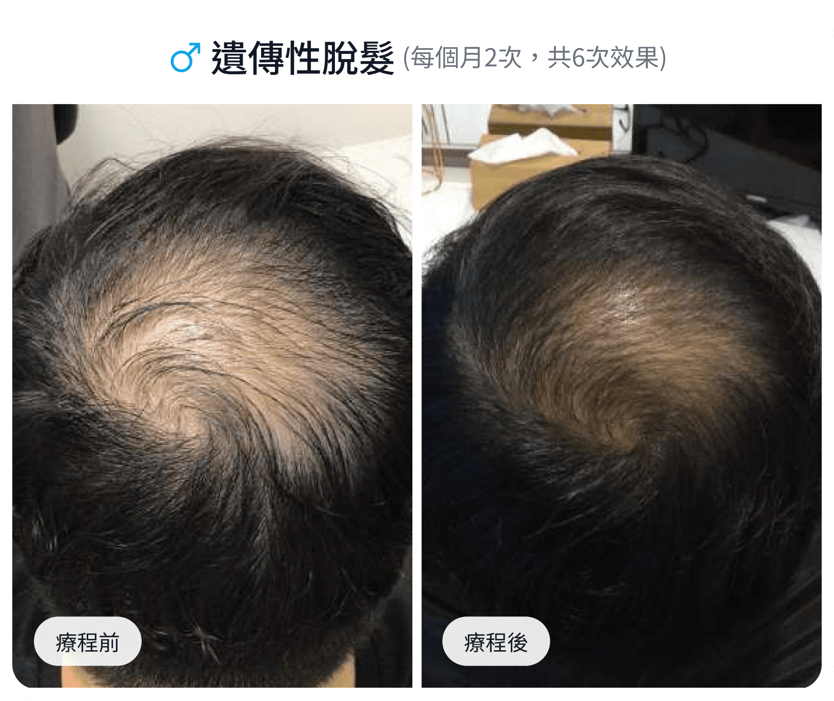 遺傳性脫髮